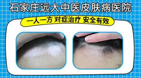 皮肤出现浅色斑慢慢变白是怎么回事