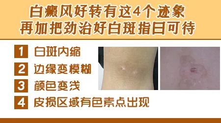 节段型白癜风用他克莫司软膏有用吗