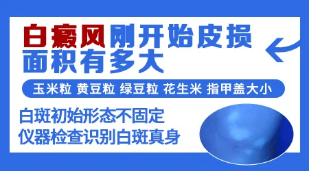白癜风面积百分之几算轻度