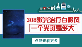 308一个光斑有多大 激光治白癜风花多少钱