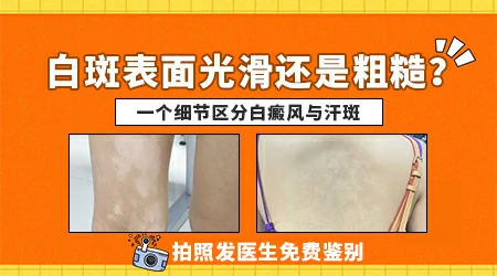 花斑癣的白斑和白癜风怎么区分