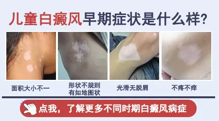 儿童轻度白斑早期症状