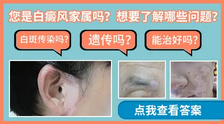 父母有白癜风孩子一定会有吗