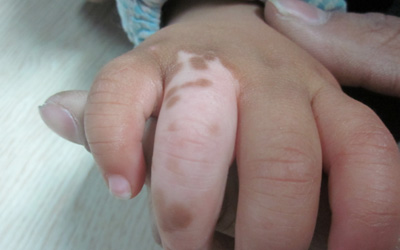 一周岁宝宝手指关节处白了一块是什么
