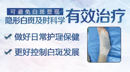 隐形白癜风可以控制不显露吗