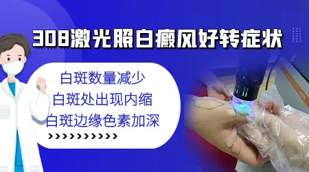 白癜风照308激光治疗后好转的迹象有哪些