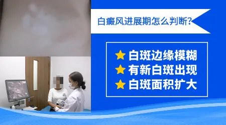 如何判断白癜风是否处于进展期