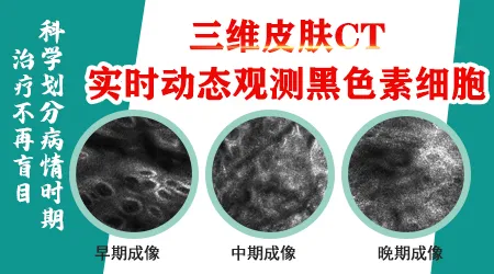 白癜风进展期和稳定期怎么区分