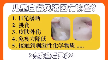 宝宝大腿根白癜风
