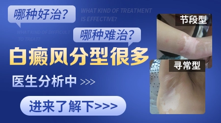 不同类型的白癜风治疗方法一样吗