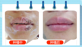 嘴唇白癜风新治疗方法