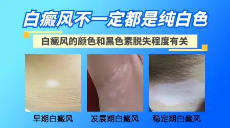 白癜风是纯白色的吗