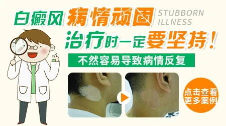 白癜风好转会有什么表现图片