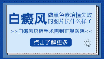 做黑色素细胞移植两个月没复色是不是就是失败了