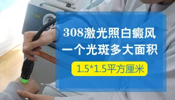 308激光照白癜风能照多大面积