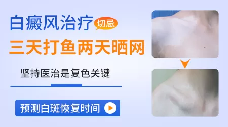 白癜风好复色吗治疗难度大不大