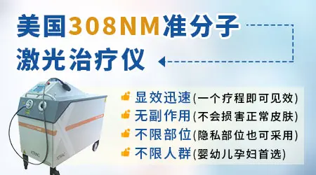 孩子嘴角长白癜风照308激光好吗
