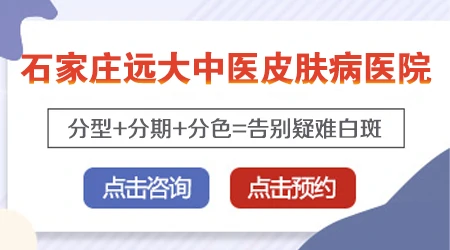 不同白癜风类型怎么区分