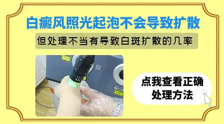 白癜风光疗后皮肤起水泡正常吗