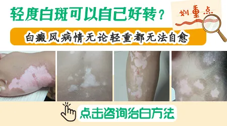 初期白癜风不治疗会扩散到全身吗