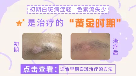 早期白癜风治疗难度大吗