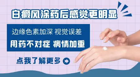 涂卤米松白癜风加重是不适合吗