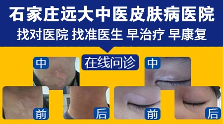 石家庄治疗白癜风挂哪个专家号