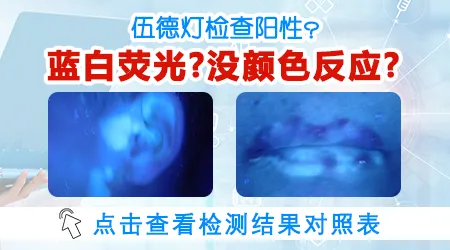 伍德灯检查结果阳性就一定是白癜风吗