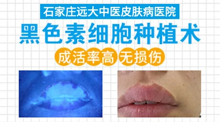 石家庄哪个医院做白癜风植皮手术好