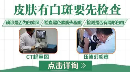皮肤有淡白色斑块就是白癜风吗