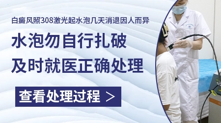 白癜风光疗起泡后多久能恢复光疗