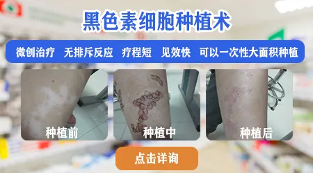 白癜风做黑色素细胞移植手术靠谱吗