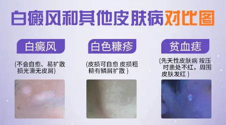 儿童脸上长白色斑块什么原因造成的