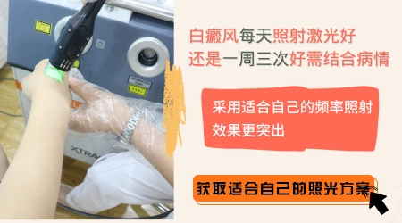 308激光照白癜风一个星期照几次