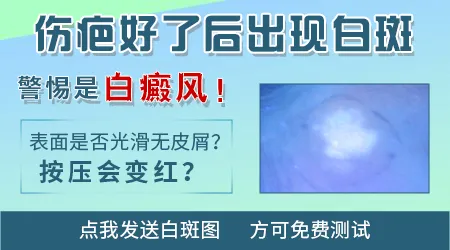 身上长白斑之前有过轻微擦伤有关系吗