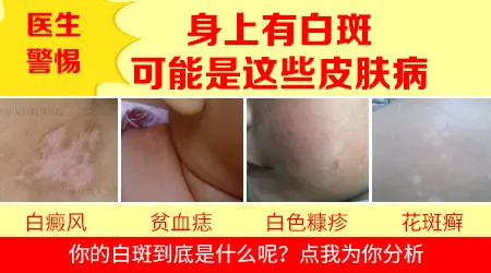 手指变白是什么病