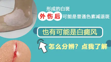 孩子皮肤外伤出现白斑会是白癜风吗