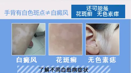 手背白斑初期症状