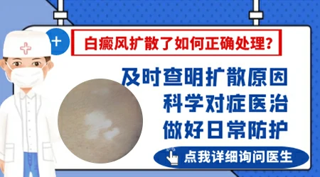 白癜风进展期怎么判断 进展期白斑图