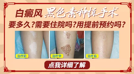 白癜风做植皮手术大概要多久多少钱