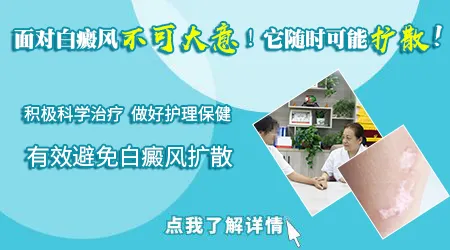 儿童白癜风会扩散到全身吗
