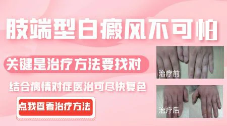 肢端型白癜风是不是治不好了