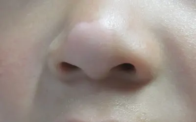 鼻子出现白斑意味着白癜风