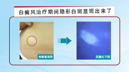 Wood灯检查能发现隐性白斑吗
