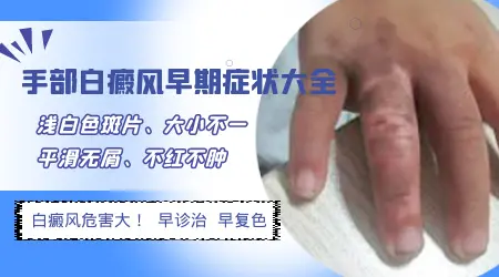 手部白癜风早期症状图片 手指白点是不是白斑