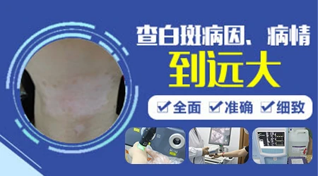 白癜风的发病原因怎么能检查出来