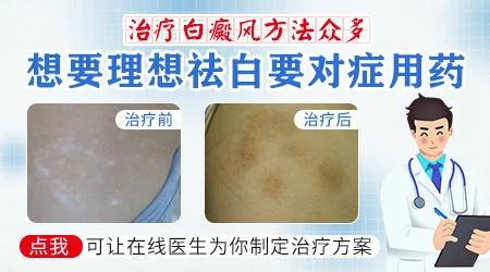 贫血痣和白癜风的区别图解