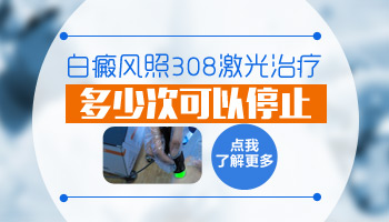 初期白癜风照308激光多少次后可以停止