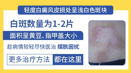 早期轻度白癜风治好大概要花多少钱