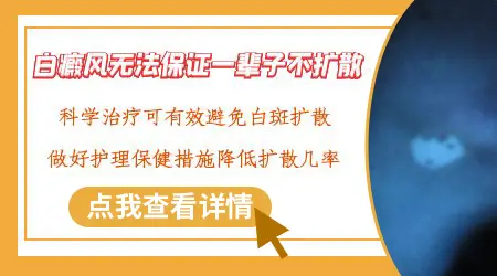 有没有长白癜风终身不扩散的